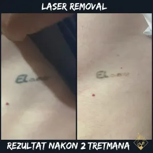 laser-removal-00