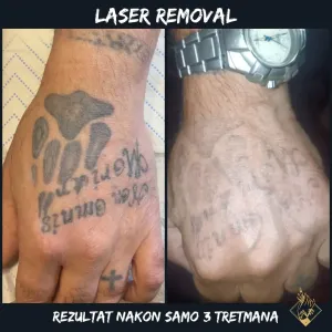 laser-removal