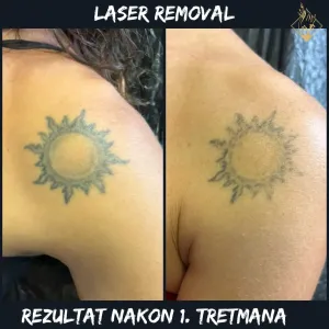 laser_removal