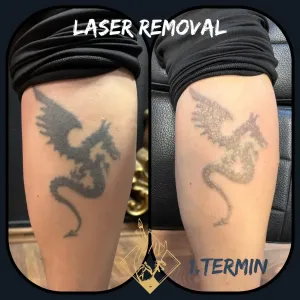 lasersko-uklanjanje-tetovaza-2