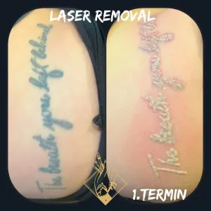 lasersko-uklanjanje-tetovaza-4