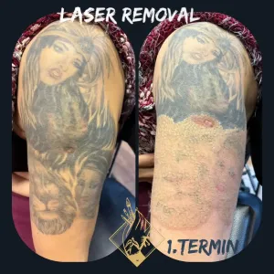 lasersko-uklanjanje-tetovaza