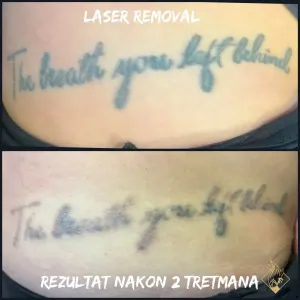 tattoo-removal-01
