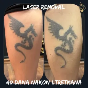 tattoo-removal-02