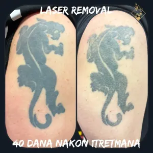 tattoo-removal-03